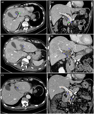 Case report: Concurrent pylephlebitis and subarachnoid hemorrhage in an octogenarian patient with Escherichia coli sepsis